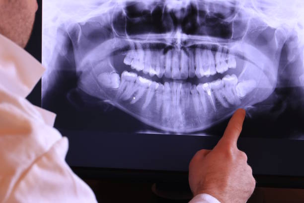 Best Emergency Wisdom Tooth Extraction in Redland, AL